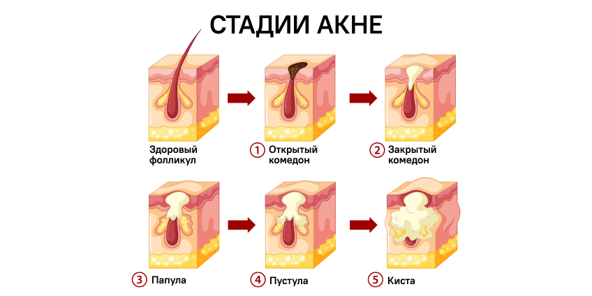 Угревая болезнь